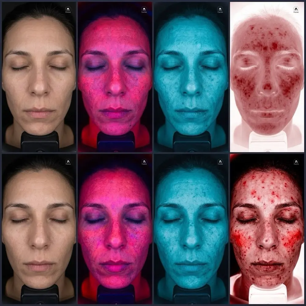 A mesma pele registrada em quatro espectros de luz: natural, ultravioleta, polarizada e vermelho